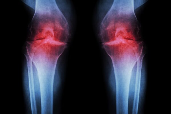 Stanford Researchers Unveil Regrowth Method for Worn-Out Cartilage